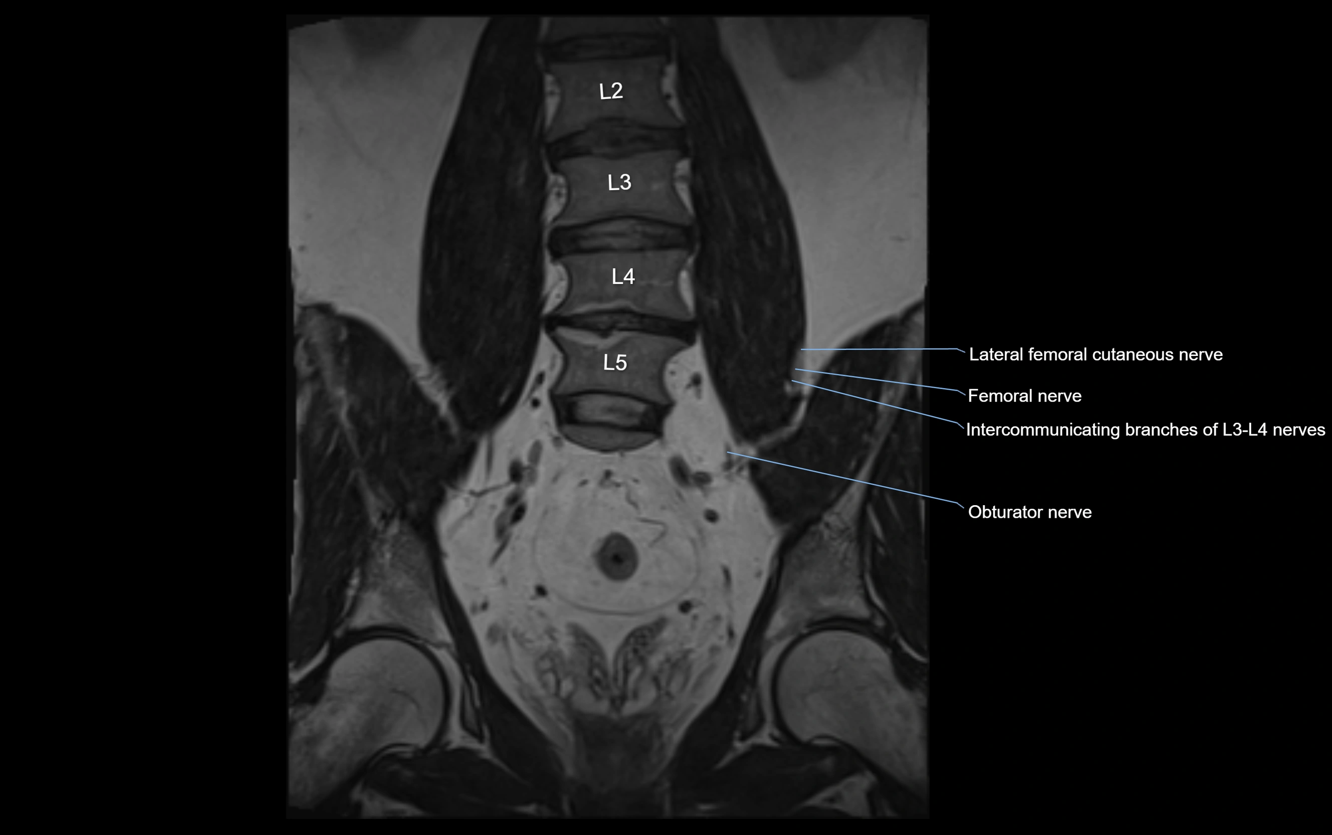 MR lumbosacral plexus cross sectional anatomy 3T  radiology  image-img-09001-00026.webp
